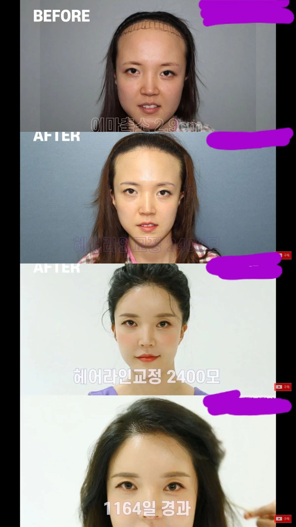 이슈/유머 - 현실감탄 절로 나오는 이마축소수술+헤어라인 교정 후기